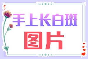 白巅风病能治好吗