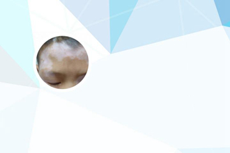 白巅峰怎么治疗