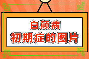 白癫疯能治好