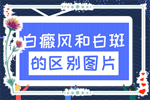 得了白点癫风能治好吗视频教程