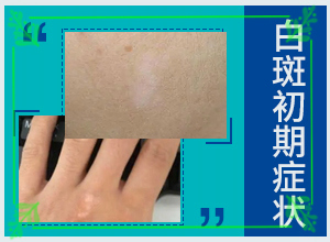 [更有保障]白癜风治疗费用-白癜风治疗效果哪里好