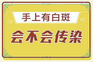 新生儿白点癫风能治愈吗