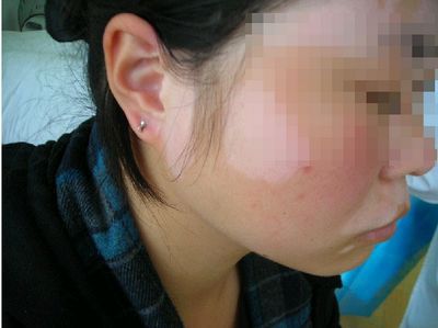 儿童白癜风症状 儿童白癜风症状