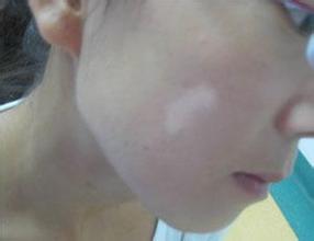 女性白癜风 女性白癜风