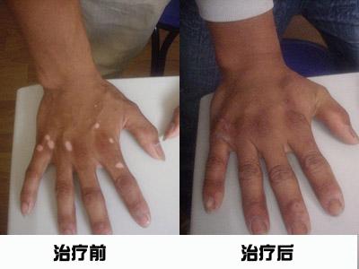 白癜风的危害 白癜风的危害