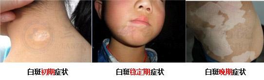 女性白癜风 女性白癜风