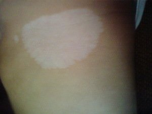 儿童白癜风治疗 儿童白癜风治疗