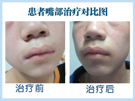 白癜风症状 白癜风症状