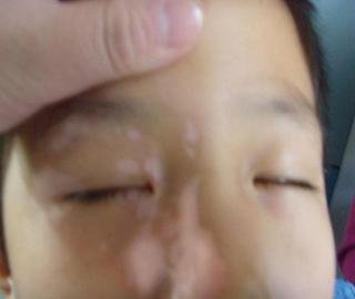 白癜风常识 白癜风常识