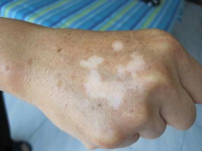 白癜风临床症状 白癜风临床症状